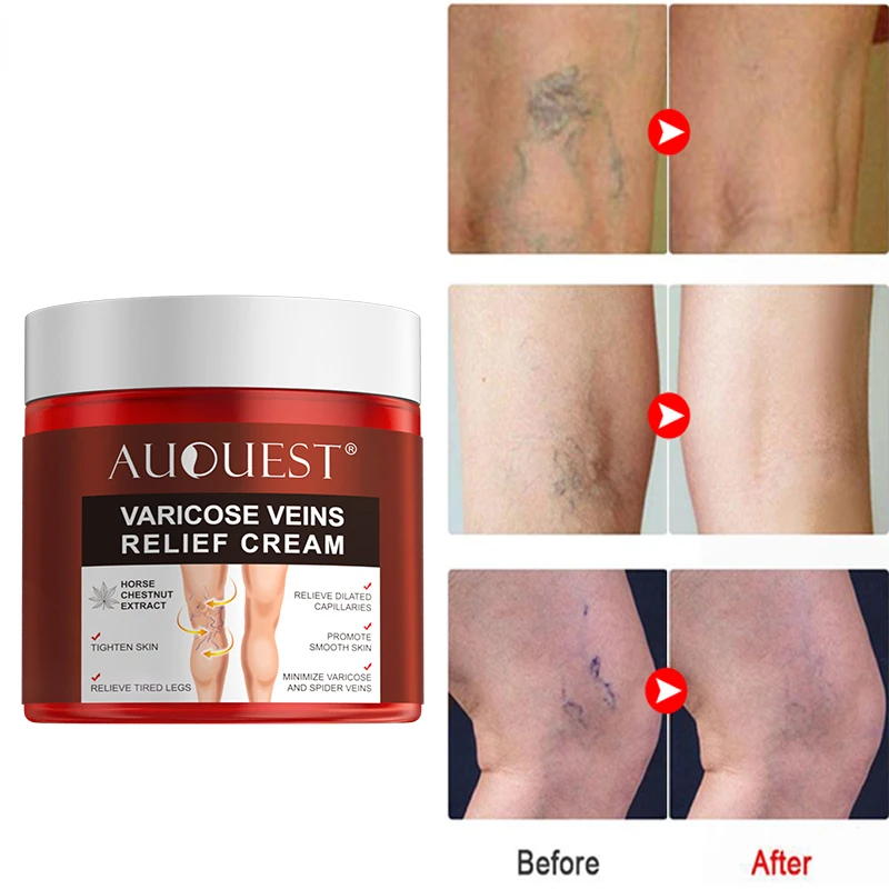 

AUQUEST Varicose Veins Treatment Cream Relieve Tired Legs Dilated Vasculitis Phlebitis Spider Pain Relief Ointment Body Care 80g