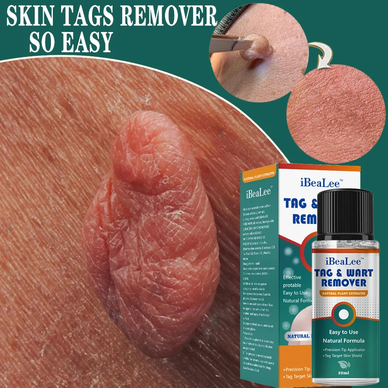 

Skin Tags Remover Painless Mole Skin Dark Spot Warts Remover Serum Freckle Face Wart Tag Treatment Removal Cream Essential Oil