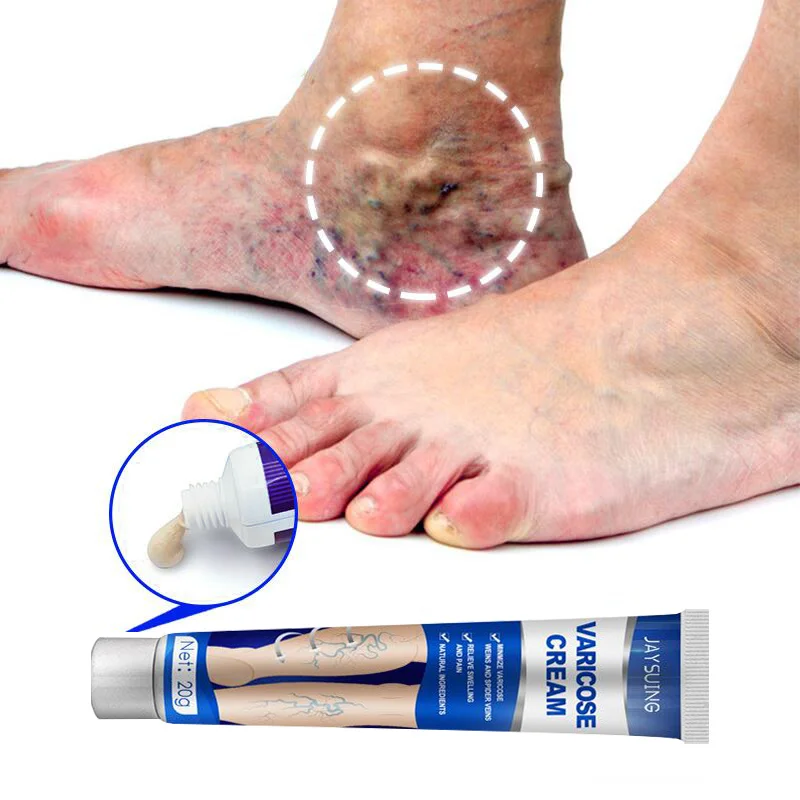 

Varicose Veins Treatment Cream Herbal Vasculitis Phlebitis Spider Pain Relief Ointment Relief Tired Leg Dilated Repair Body Care