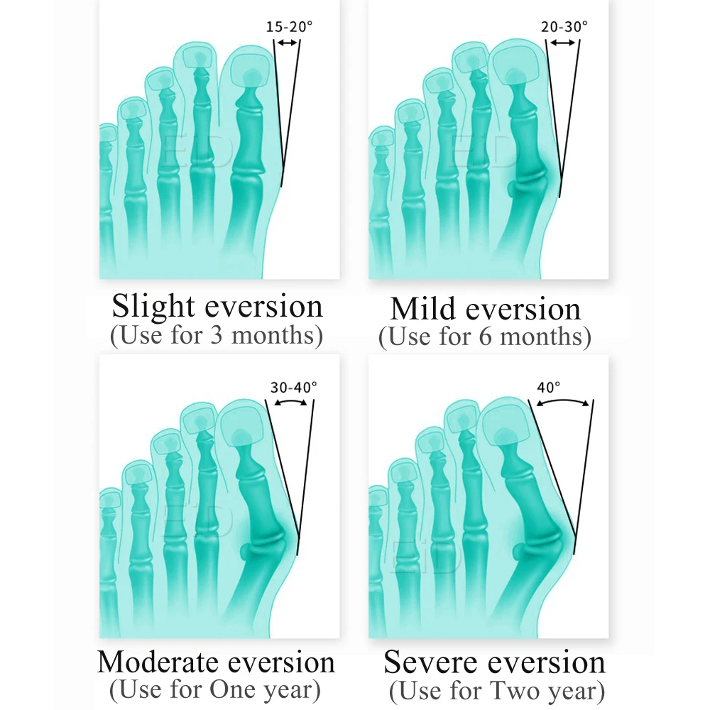 EiD Silicone Gel Toes Separator fot Hallux Valgus Orthotic Insoles Toe Correction Cushion Forefoot Pad Inserts Foot care Unisex