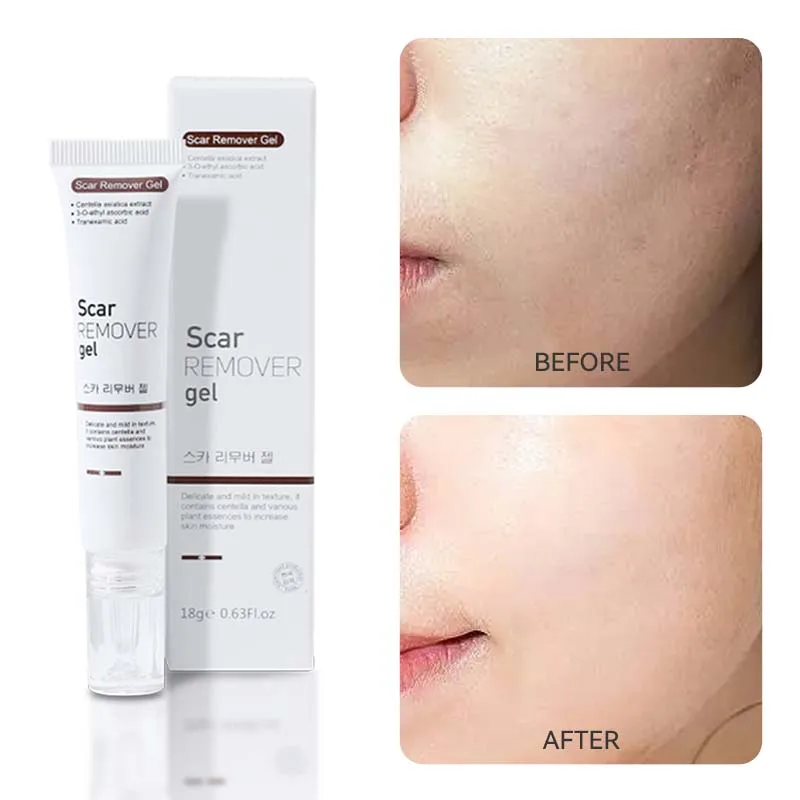 

Acne Cream 18ml Deep Fade Acne Scar Acne Prin Remove Acne Whitening And Rejuvenating Skin Safe Mild Acne Cream Skin Care