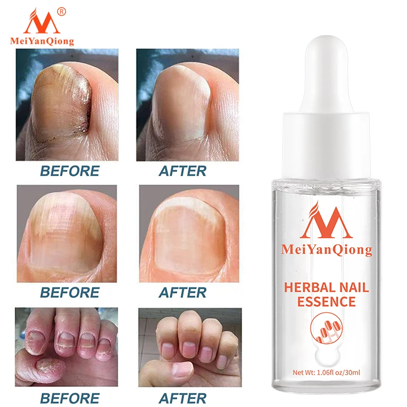 

Fungal Nail Treatment Feet Care Essence Nail Foot Whitening Toe Nail Fungus Removal Gel Anti Infection Paronychia Onychomycosis