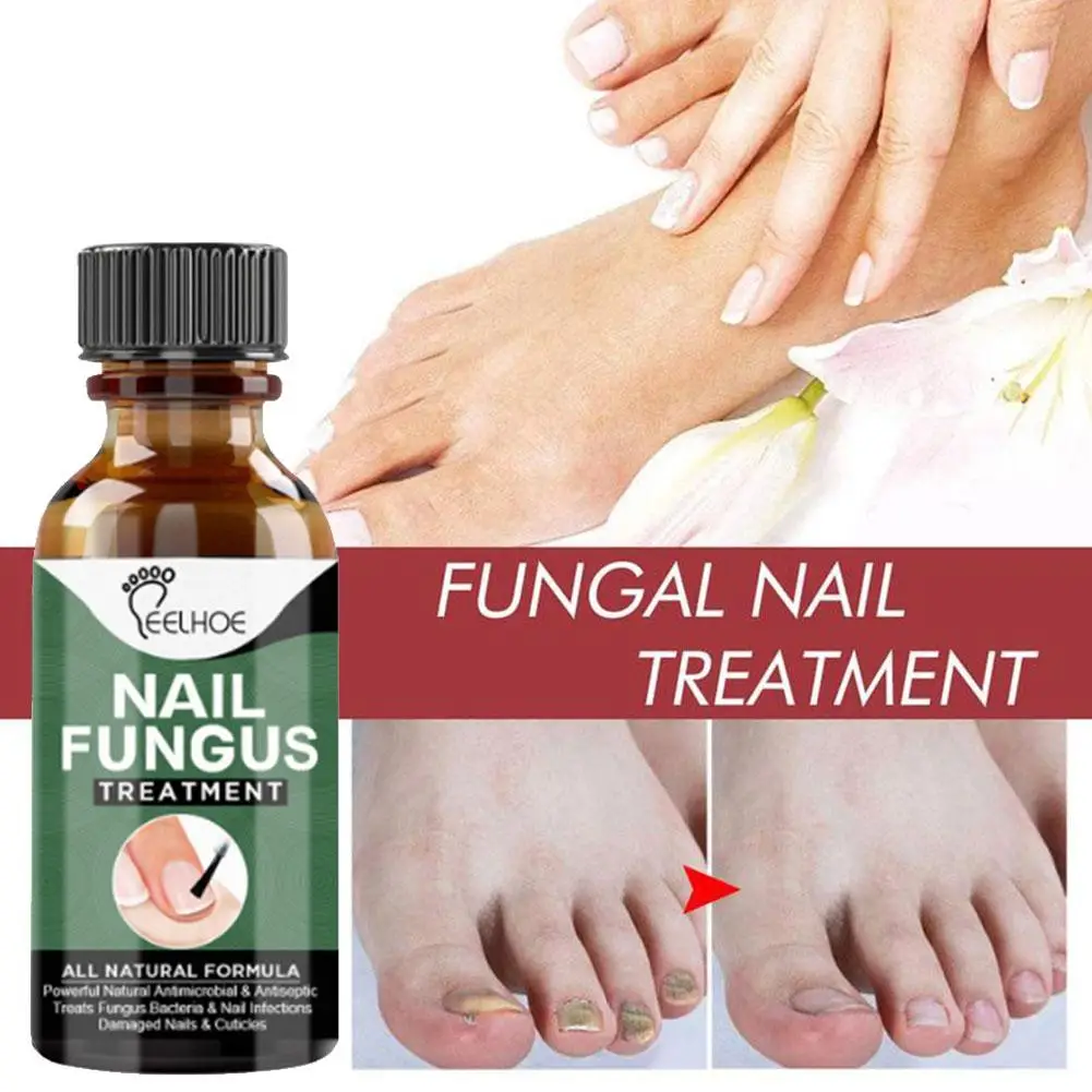 

Крем для ногтей Восстанавливающий жидкий биологический Восстанавливающий аппарат для ногтей Удаление онихомикоза уход за псориазом брикет 30 мл против ногтей N9M9