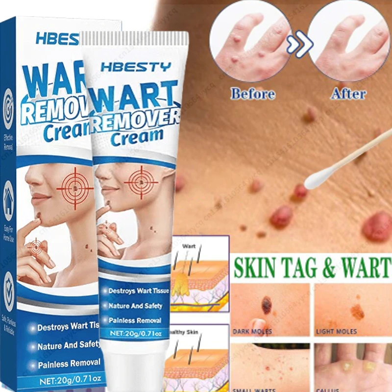 

Mole Dark Spot Warts Remover Skin Wart Spot Tag Remover Cream PainlessSerum Freckle Face Wart Treatment Removal Essential Oil