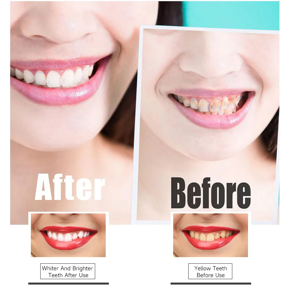 Newest PAP Charcoal Gel Teeth Whitening Strips Activated Bamboo Dental Veneers Tooth Bleaching Stain Removal Oral Hygiene Care images - 6