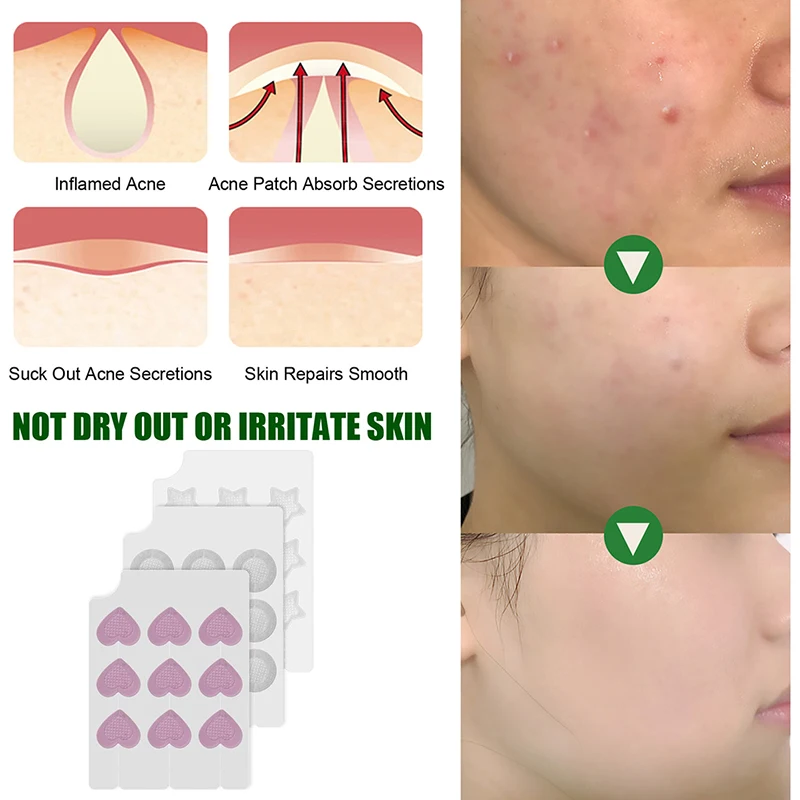 Наклейки Микроиглы против прыщей Удаление Успокаивающая кожа Пластыри для лица