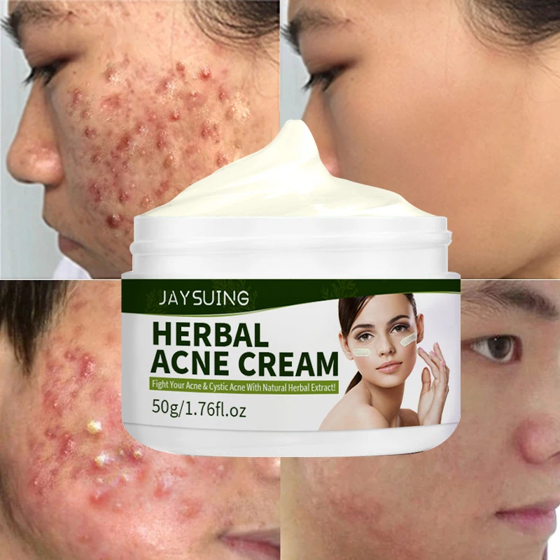 

Herbal Acne Removal Face Cream Effective Treatment Acne Scar Spots Gel Oil Control Whitening Moisturizing Skin Care Products 50g
