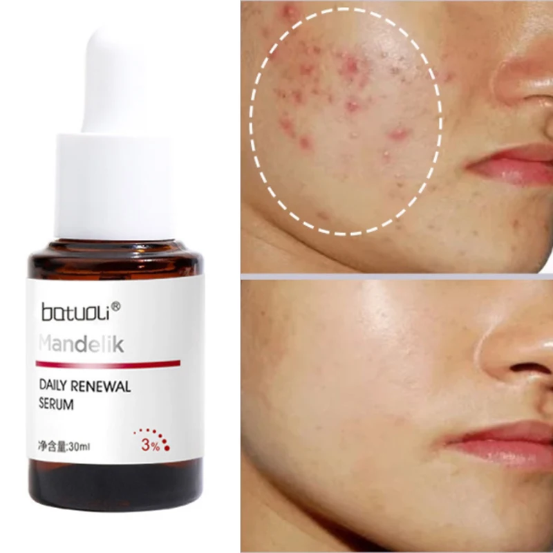 

30ml 1% Mandelic Acid + 2% Salicylic Acid Acne Treatment Face Serum Anti Acne Shrink Pores Essence Whitening Repair Pimple Scar