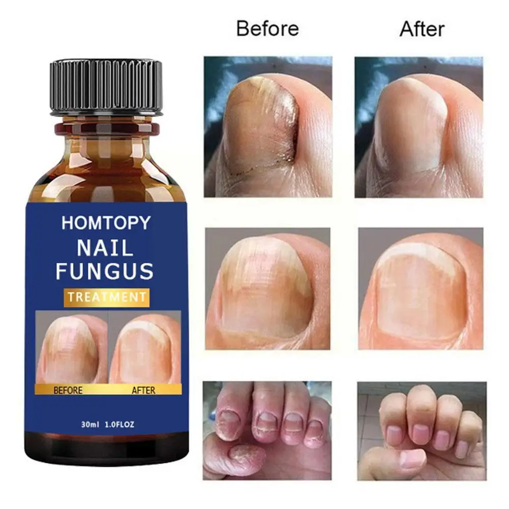 

30ml Nail Care Essence Oil Straighten Nails Relieve Pain Support Nails Nail Hardener Nail Healthy Repair Regeneration Antif N9Y7