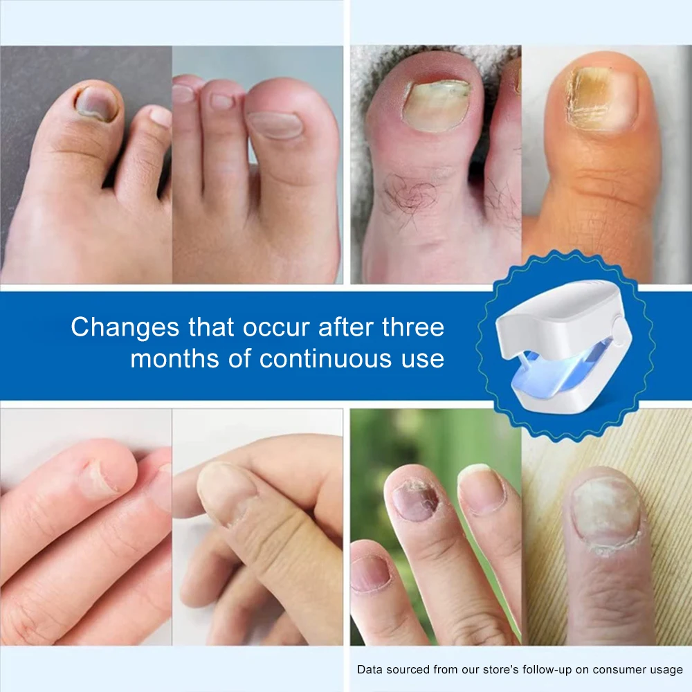 Электрическое устройство для лечения грибка ногтей противогрибковое средство