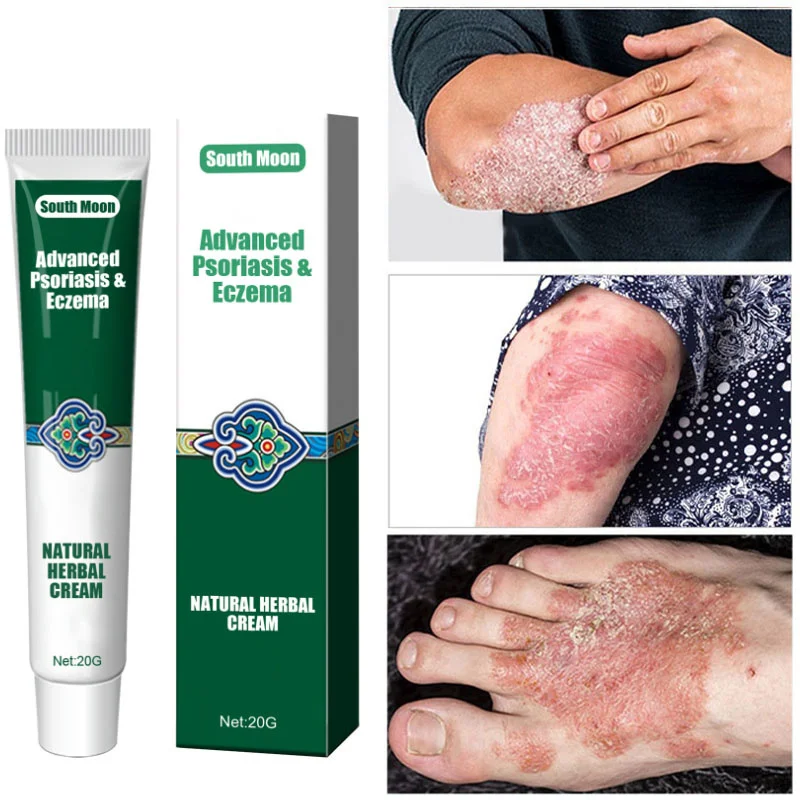 

Herbal Psoriasis Treatment Cream Effective Antibacterial Anti-itch Relief Dermatitis Eczema Ointment Urticaria Desquamation Care