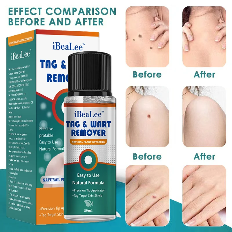 

Skin Tags Remover Painless Mole Skin Dark Spot Warts Remover Serum Freckle Face Wart Tag Treatment Removal Cream Essential Oil