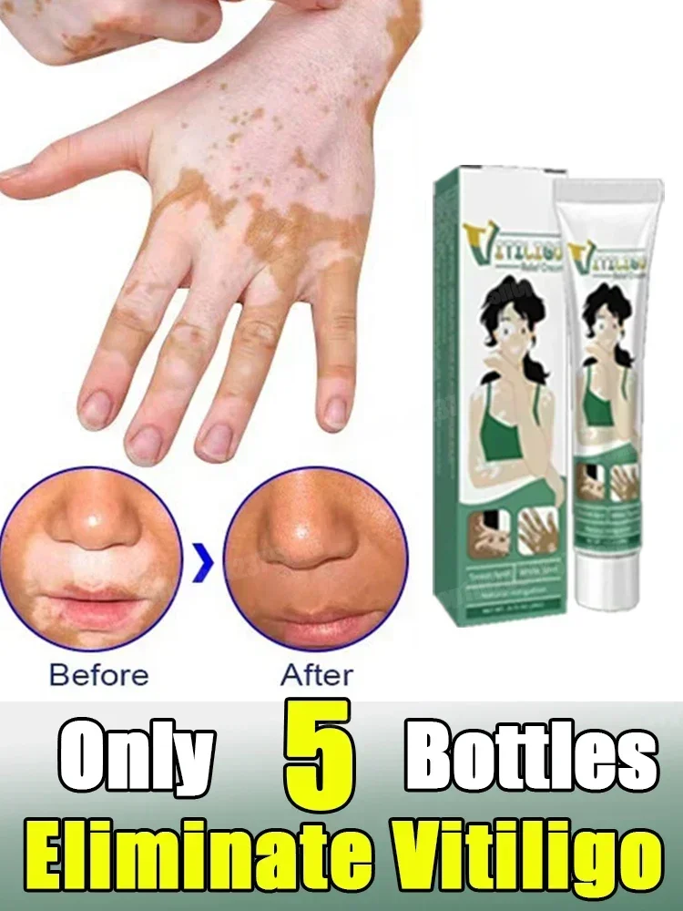 Средство для удаления лейкоплакии крем витилиго белых пятен антибактериальная