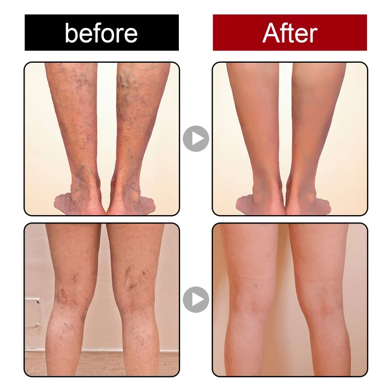 New Varicose Veins Gel Spider Treatment Relief for Legs Repair Natural Massage | Body Creams