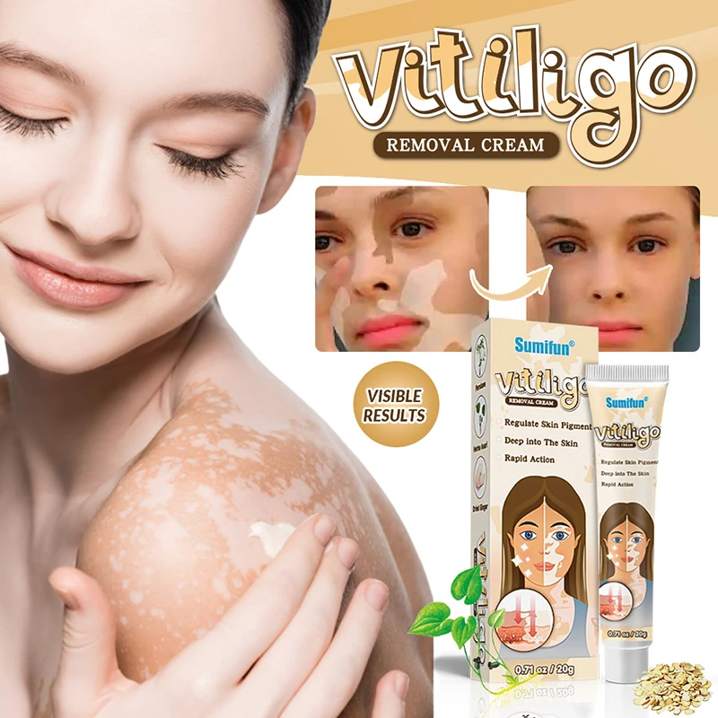 

Natural Herb Vitiligo Ointment Ringworm White Spot Remove Treat Leukoplakia Disease Restore Melanin Pigment Relief Skin Cream