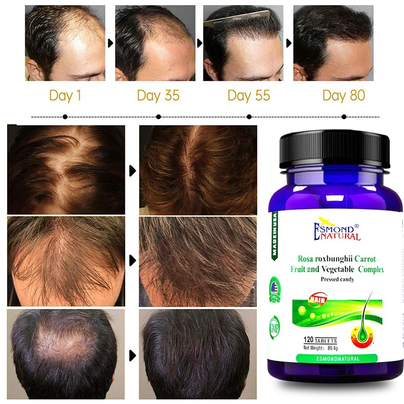 Hair Growth Nutritional Supplements Prevent Hair Loss Dredge Hair Follicles Fast Hair Growth Inhibit Oil Secretion images - 6