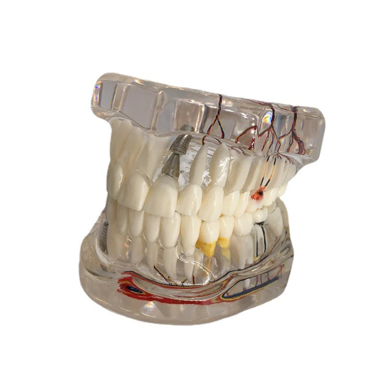 

Teeth Neural Repair Dental Implant Pathological Model Dentist Students Communication Learning Research Oral Disease Education