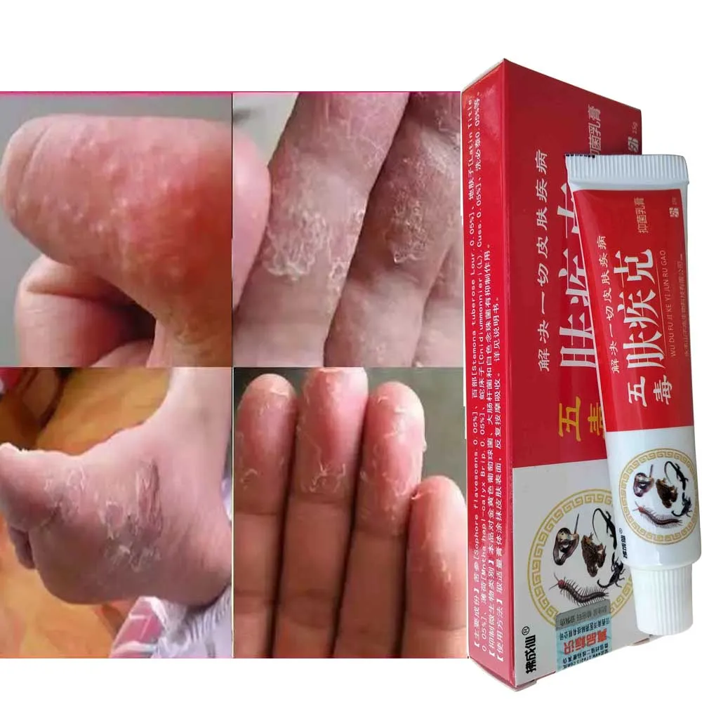 

Fungal Vesicle Antibacterial Cream Psoriasis Herbal Treatment Eczema Anti-itch Relief Rash Urticaria Desquamation Ointment