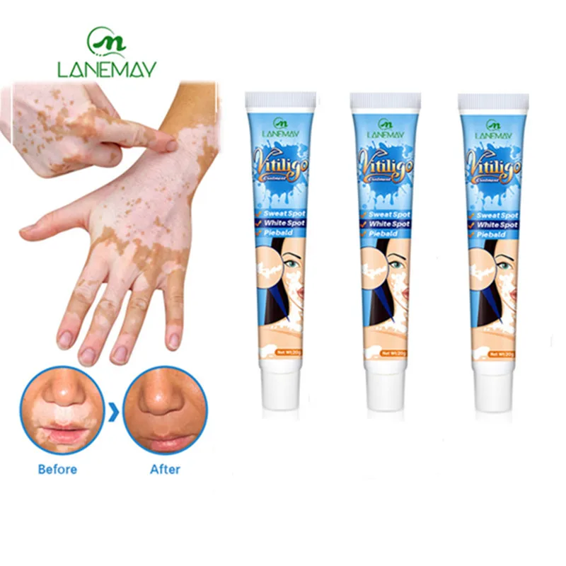 Herbal Extract Vitiligo Ointment Remove Ringworm Body White Spot Effective Itch Repair Original Skin Moisturize Treatment Cream