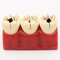 1 piece 41 size dental caries removable teeth tooth model learn study model
