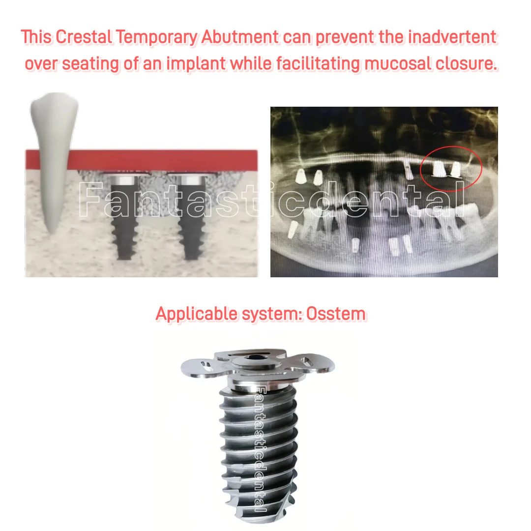 Фото Временные абатменты Dental Crestal для синус-лифтинга, тонкие, подходят для винтов с широким кончиком OSS №2