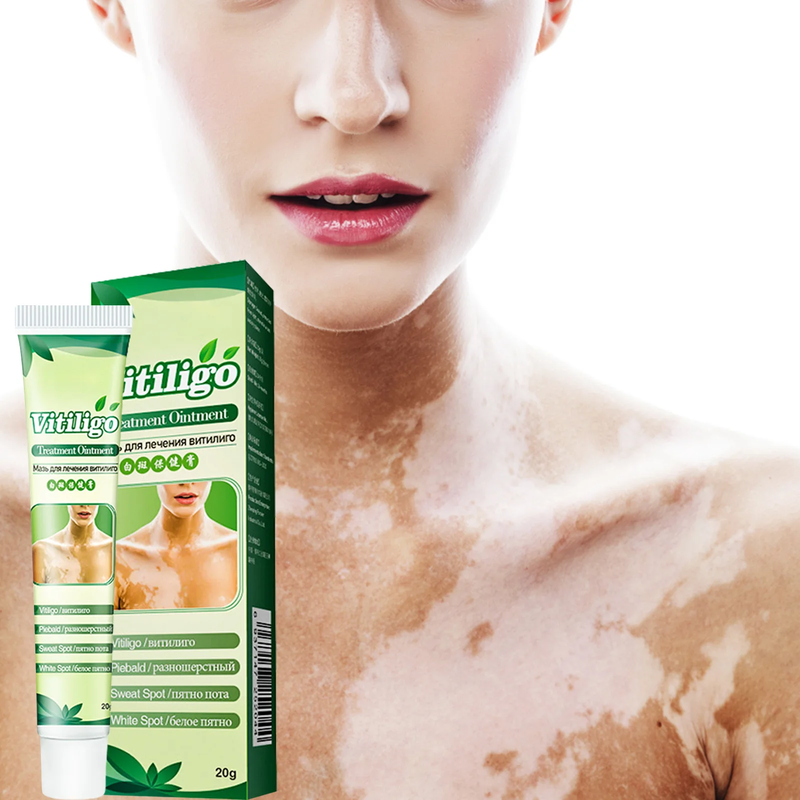 

Vitiligo Treatment Cream Skin Pigmentation Treatment Vitiligo Care Cream Or Skin Vitiligo Leukoplakia Improve Skin Pigmentation