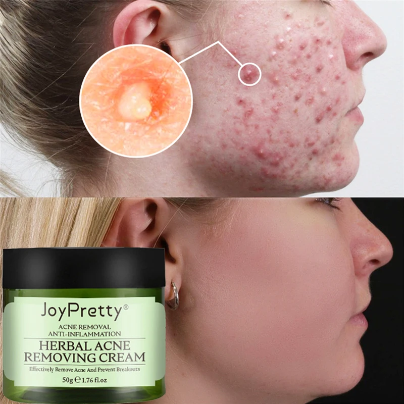 

Натуральный травяной крем для лечения акне на лице, 1 шт., увлажняющий восстанавливающий крем для удаления пятен от прыщей, косметический ух...