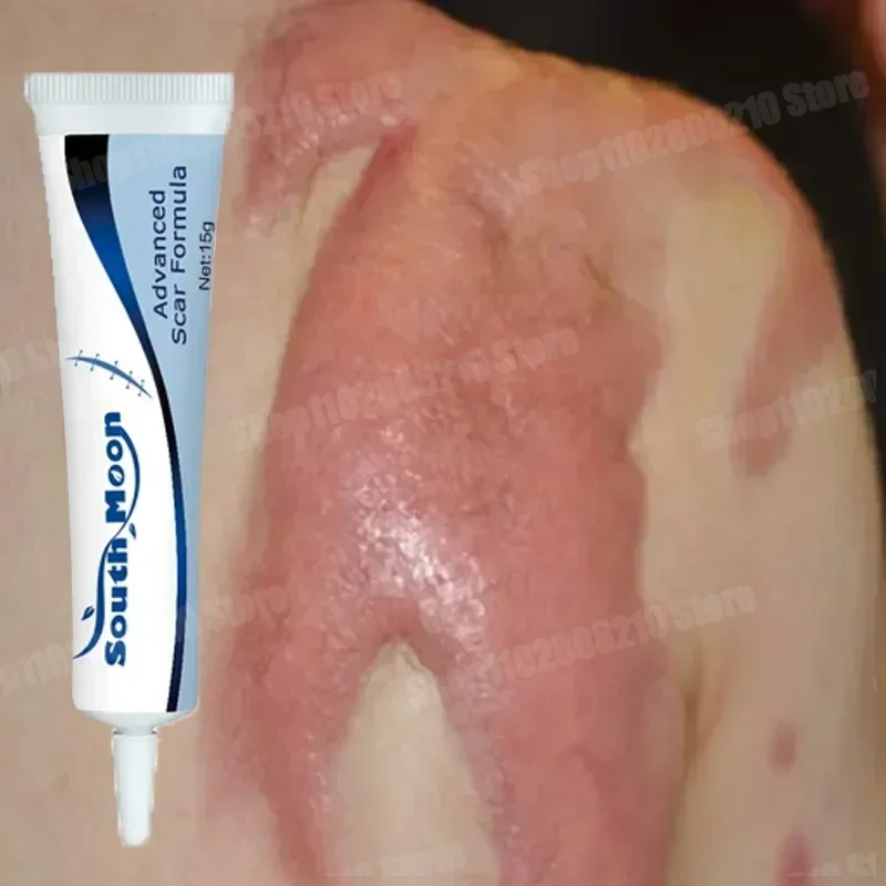 Новый и старый крем для удаления шрамов растяжки от прыщей ожоги хирургический