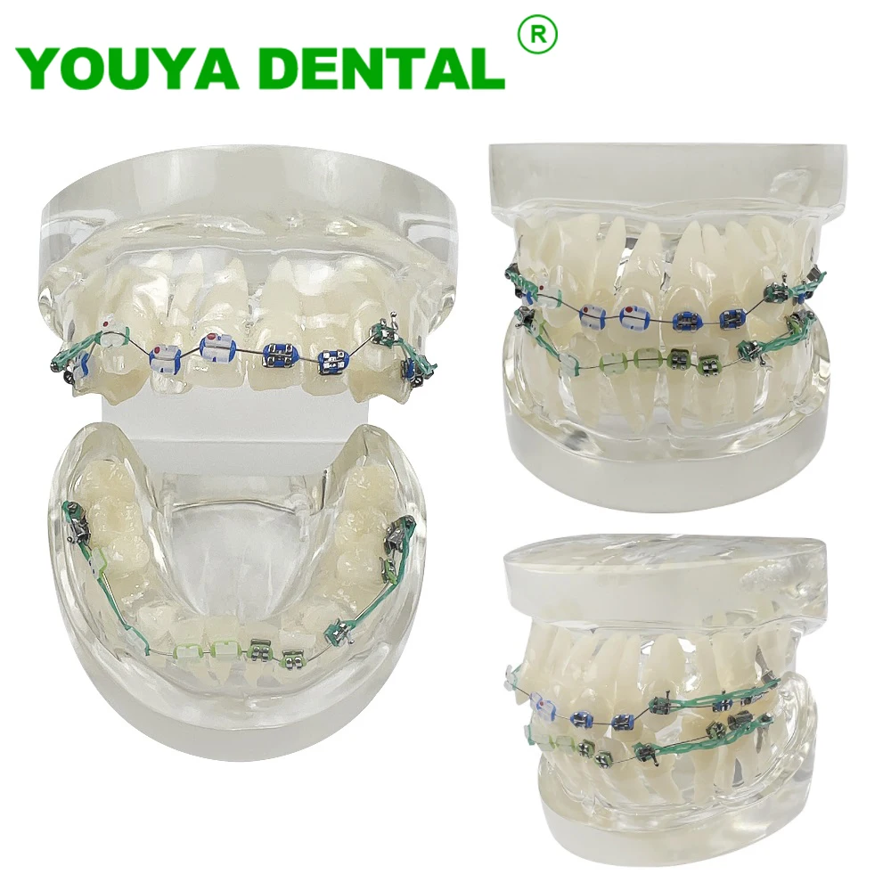 Ортодонтическая модель зубов с металлическими и керамическими звеньями