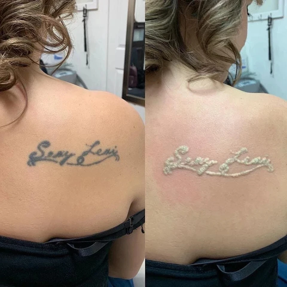 CE портативный q переключатель nd yag аппарат нм отбеливание кожи удаление пигмента