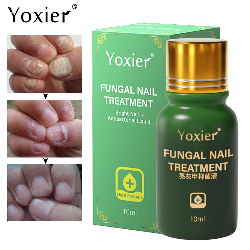 Сыворотка для лечения грибка ногтей антиинфекционное удаление онихомикоза