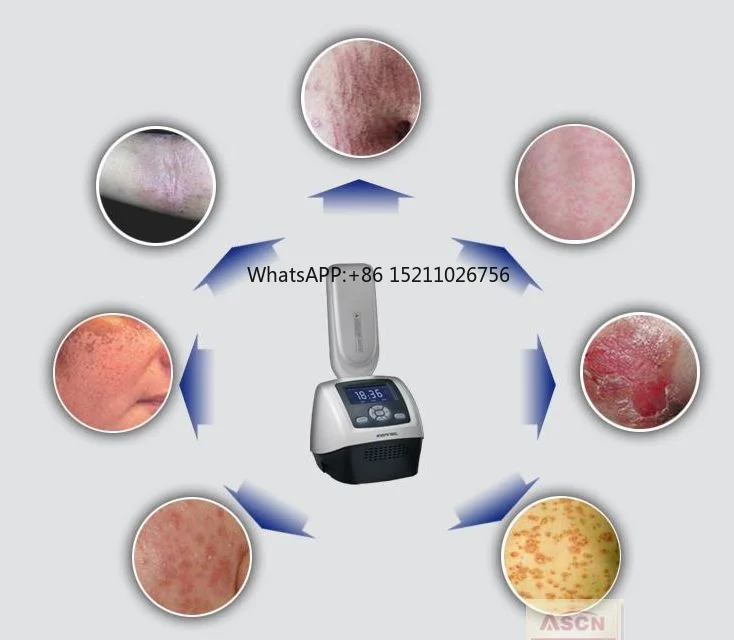 Медицинское оборудование Kernel УФ-фототерапия 311 узкополосные УФ-лампы для