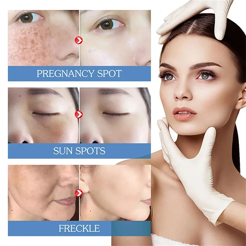 Эффективное средство для удаления мелазмы темных пятен крем осветляет гладко