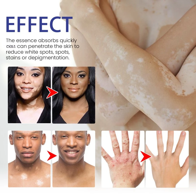 Сыворотка для лечения Vitiligo лампа роста пигмента Ringworm Tinea удаление пота и белых