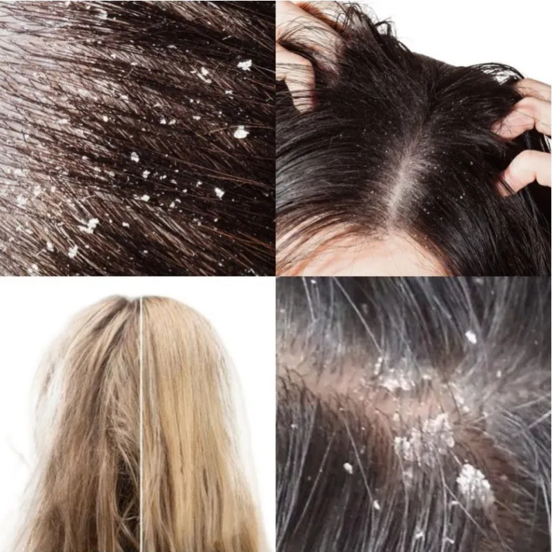 

HOT Shampoo Anti Dandruff Itching Strong Antipruritic Treatment Products Dermatitis Hair Dandruff Repair Health Care