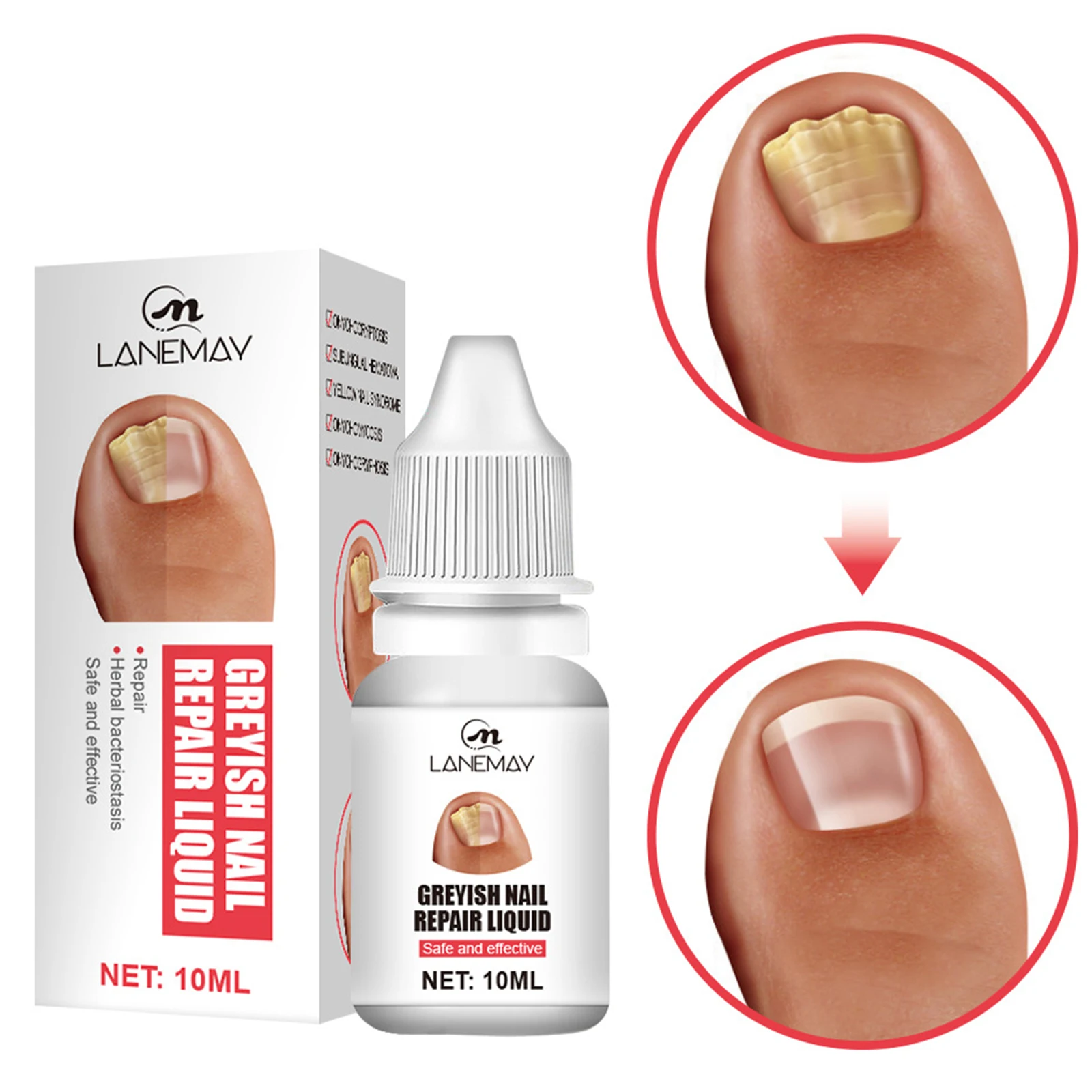 

10 мл Лечение грибка для ногтей Уход за ногами эссенция против инфекции паронихия онихомикоз для ногтей ног средство для удаления грибка