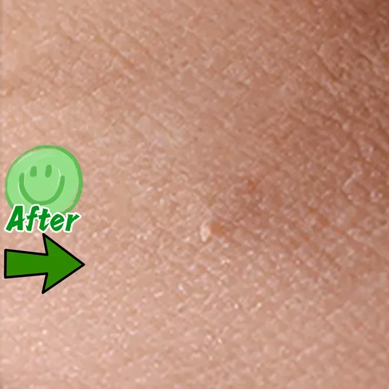 Морской невус на голове бородавки кожу головы обезьяне каулифтовая ручка