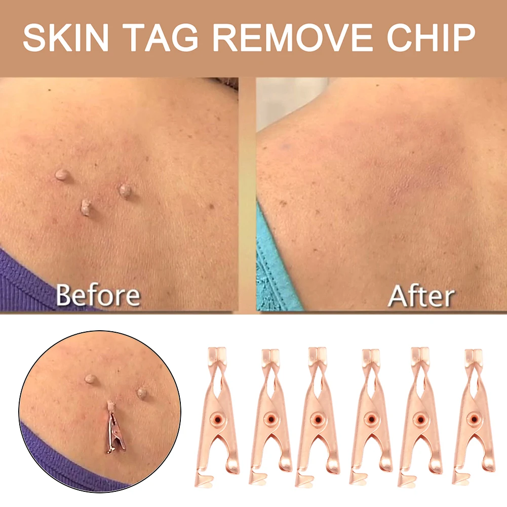 

2/6 шт., прищепки для удаления бородавок