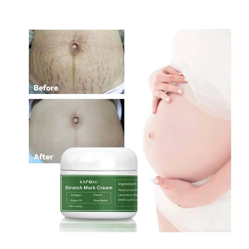 

Stretch Marks Remover Cream Skin Care Treatment For Woman Removal Pregnant Maternity Slackline For Pregnancy