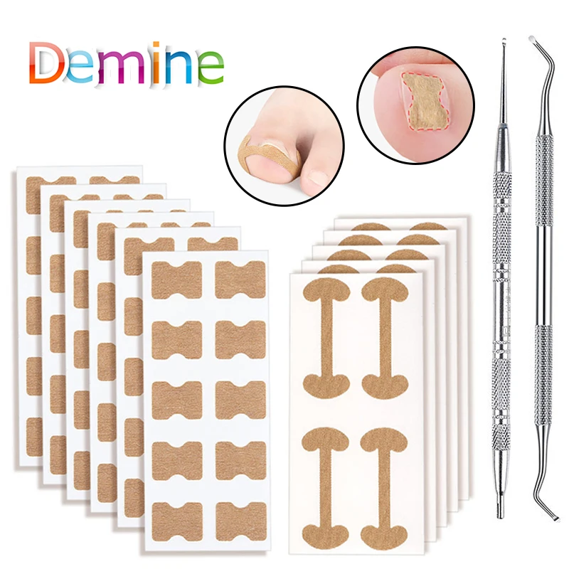 

1 Набор, корректор для ногтей ног