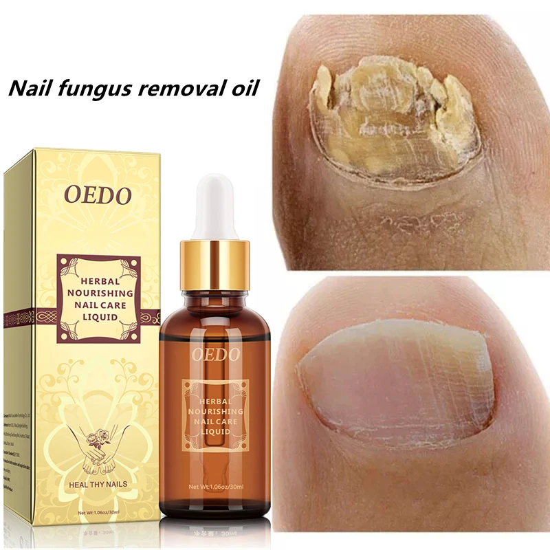 

30ml Fungal Nail Repair Essence Feet CareTreatment Foot Toe Nail Fungus Removal Gel Anti Infection Paronychia Onychomycosis Care