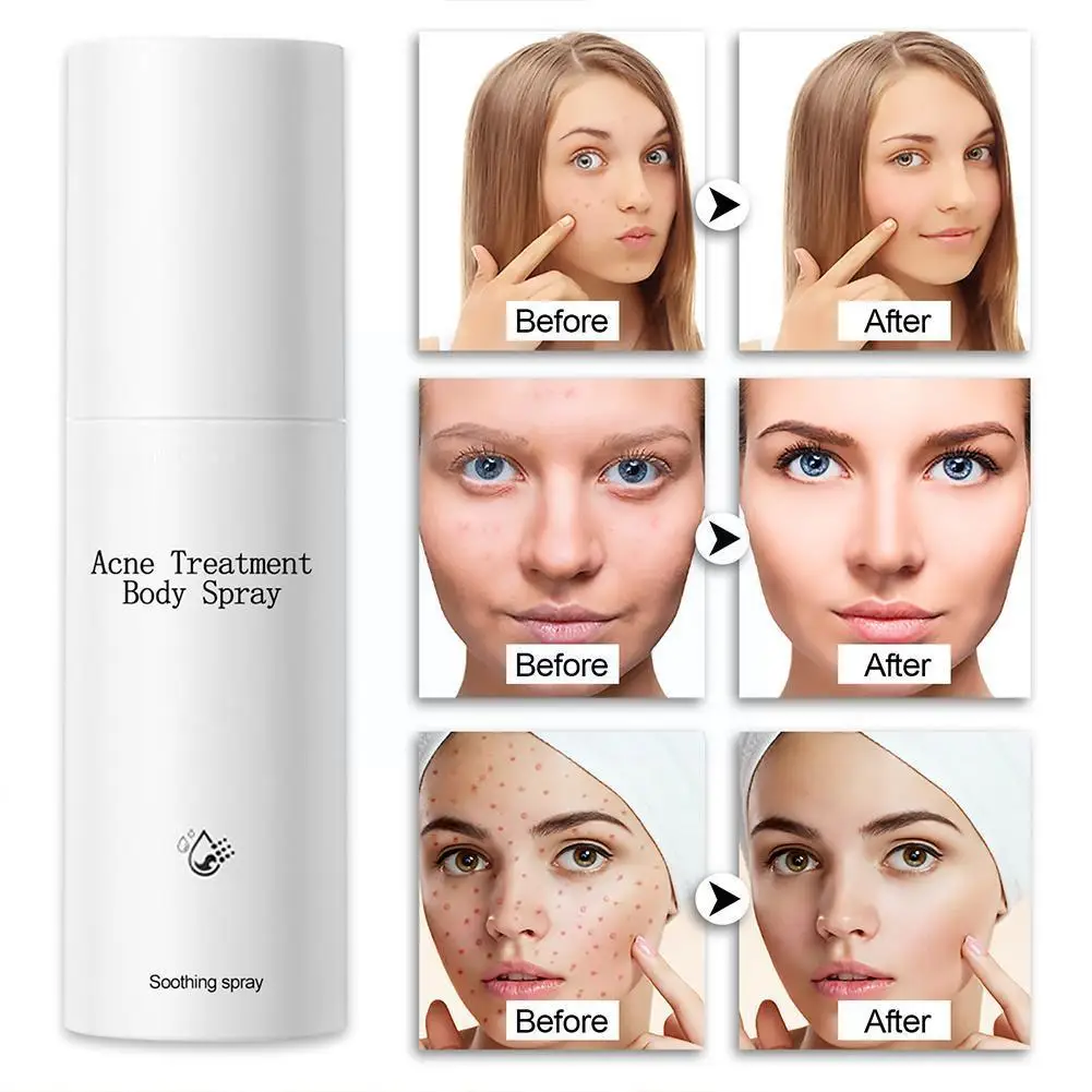 Remove Acne Spray Treatment Acne Repair Spots Liquid Water Moisturizing Whitening Spray Skin Body Anti-acne Care 100ml Face H5k0