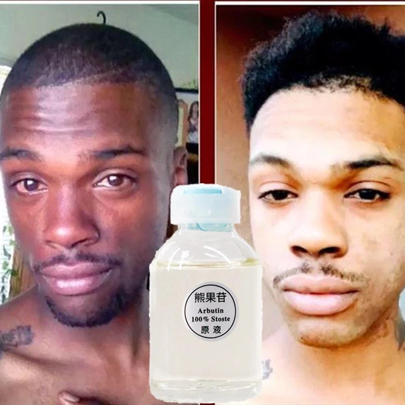 

Альфа-арбутин для кожи, 30 мл, 100%, супер отбеливающая Сыворотка для темного отбеливания и осветления, сыворотка с койевой кислотой, отбеливающий крем для красоты лица