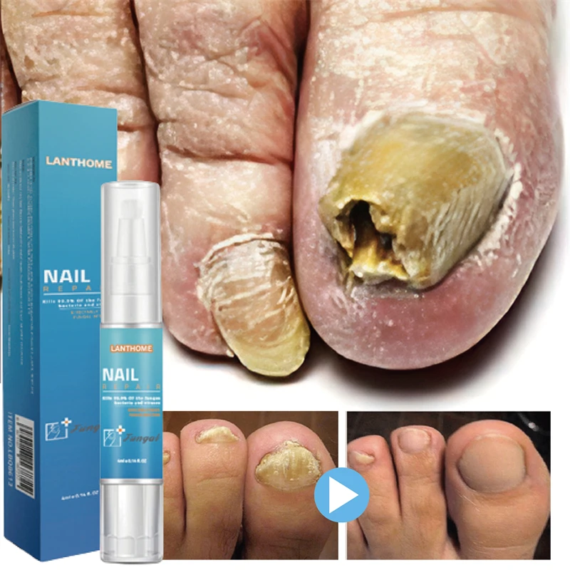 

Nail Fungal Treatment Essence Pen Anti Infection Paronychia Onychomycosis Nail Foot Toenail Fungus Removal Gel Feet Care Product