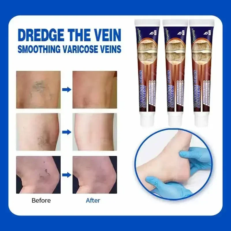 Мазь от варикозных заболеваний Мужская устройство для снятия симптомов боли в