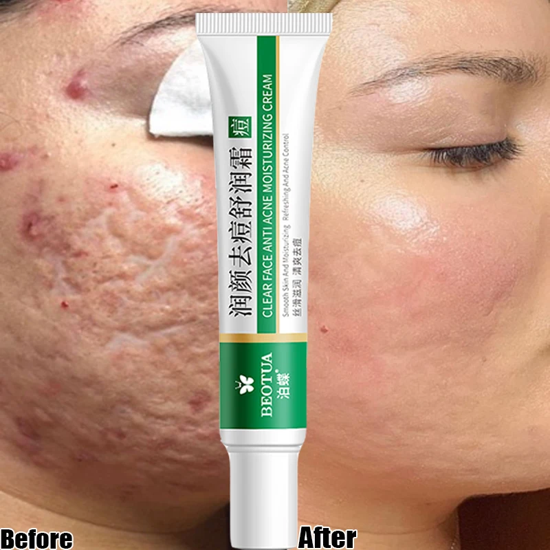 

20g Effective Acne Removal Cream Treatment Acne Scar Shrink Pores Oil Control Whitening Moisturize Cream Face Gel Skin Care
