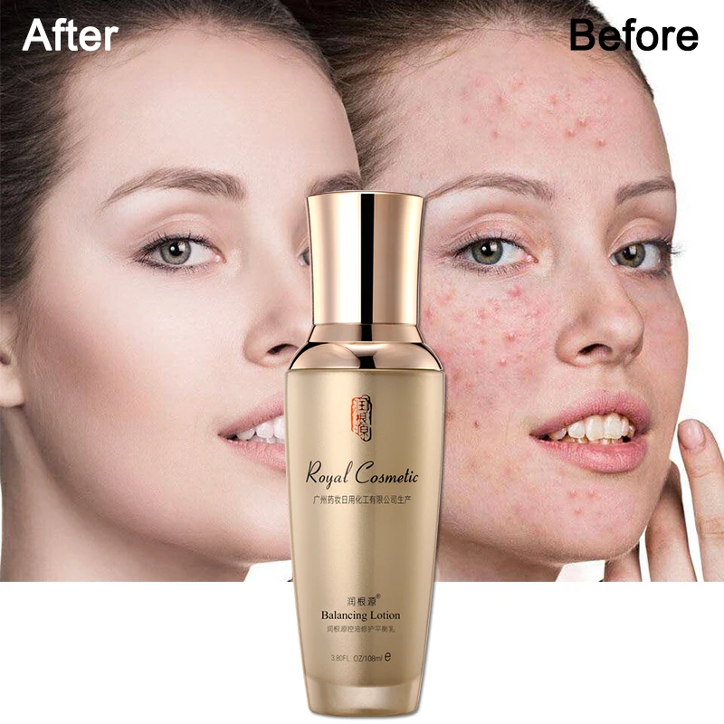 Rungenyuan Oil control repair balance lotion 108ml oily skin removal acne treatment face care kind to skin soothing melatonin