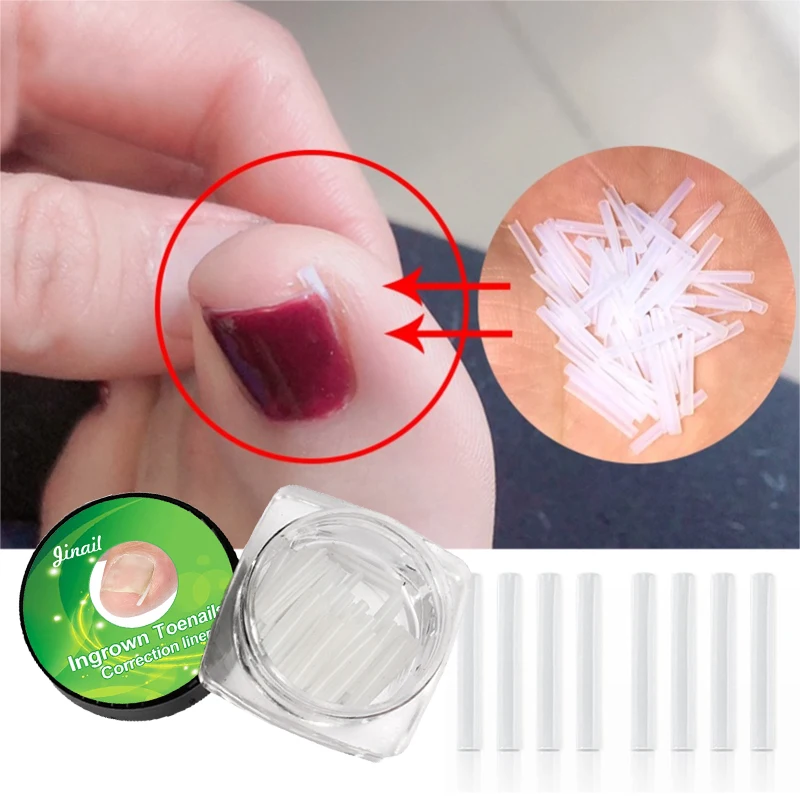 

Силиконовый инструмент для коррекции вросших ногтей, невидимый инструмент для лечения вросших ногтей, эластичный зажим для выпрямления, ин...