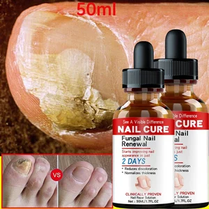 Nail Fungus Treatment Essence Serum Care Hand and Foot Care Removal Repair Gel Anti-infective Parony