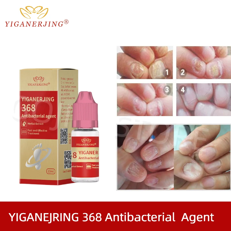 

Антибактериальный агент YIGANERJING, эссенция для ногтей, Лечение грибка, уход за ногами, против инфекции, паронихия, онихомикоз, Восстанавливающ...